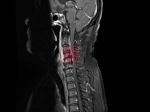 MRI of cervical spine showing epidural abscess that causes spinal cord compression and paralysis