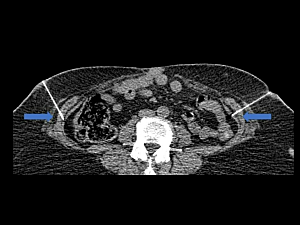 CT scan of abdominal wall with blue arrows indicating position of needle injections