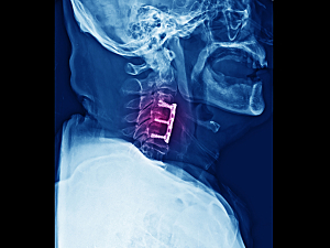 Lateral projection cervical spine x-ray showing anterior cervical discectomy and fusion or ACDF procedure.