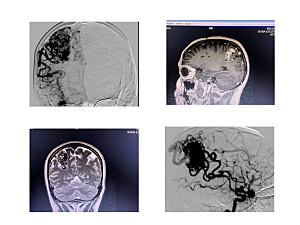 <em>4 Angiograms and MRI images show an arteriovenous malformation (AVM) in a patient before surgery</em>