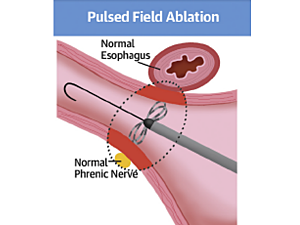 Diagram of pulsed field ablation procedure inside an esophagus