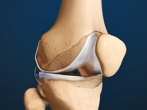 Typical synovial joint showing the bone synovial membrane synovial fluid cartilage and ligament