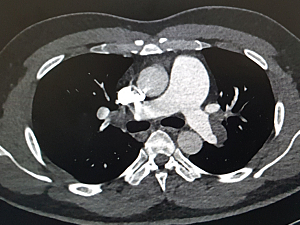 CT scan of pulmonary artery showing acute bilateral pulmonary embolism.