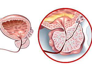 Illustration showing healthy prostate and benign prostatic hyperplasia