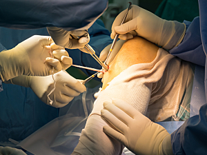 Patient knee in surgery, surgeons preparing tendon for ACL reconstruction