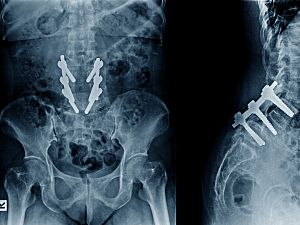 X-ray image of lumbar spine postoperative treatment for degenerative lumbar disc diseaseby decompression and fix by iron rod and screws