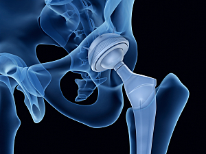 3D illustration of pelvic bone and femur, with total hip arthroplasty installed