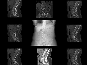 Multiple CT scans of spine, black and white, intraoperative CT scan concept