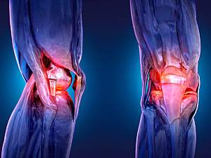 X-ray 3D medical anatomy of the knee illustration, knee arthroplasty concept