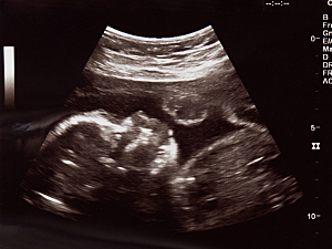 Ultrasound image of baby's head during hospital visit