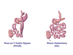 Illustrations of Roux-en-Y Gastric Bypass and Sleeve Gastrectomy on white background