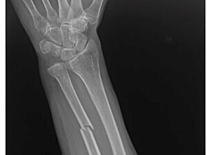 An anteroposterior radiograph of an isolated ulnar shaft fracture