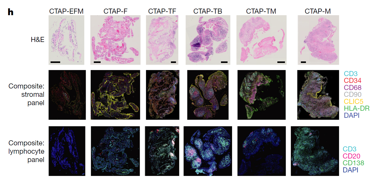 Representative synovial tissue fragments from each of the CTAPs. Top row, haematoxylin and eosin (H&E) staining. Middle row, immunofluorescence microscopy for CD3, CD34, CD68, CD90, CLIC5 and HLA-DR. Bottom row, immunofluorescence microscopy for CD3, CD20 and CD138.
