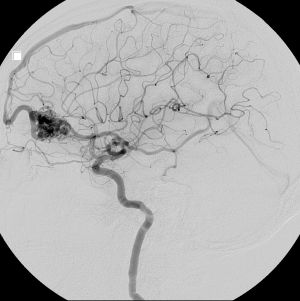 radiology image of AVM blood vessels in the brain